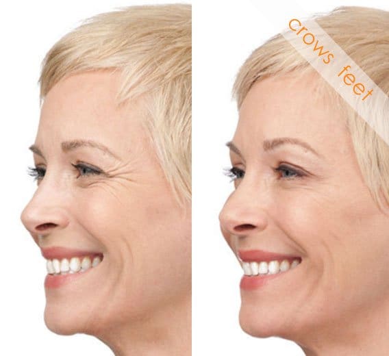 Crowsfeet Before-And-After Treatment result photos in Baltimore, MD | Green Relief Health, LLC