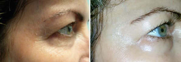 Botox Before and After Treatment result photos in Baltimore, MD | Green Relief Health, LLC