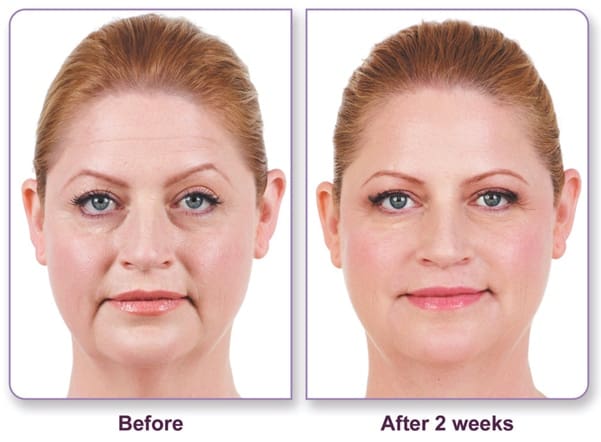 Juvederm-Before-And-After-Baltimore Treatment result photos in Baltimore, MD | Green Relief Health, LLC