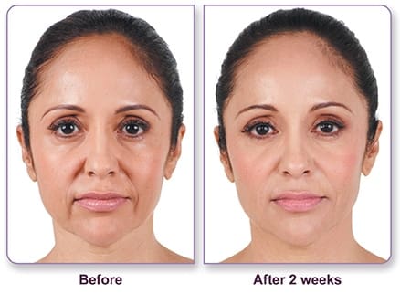 Juvederm-Before-And-After Treatment result photos in Baltimore, MD | Green Relief Health, LLC