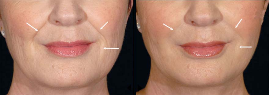 Restylane-Before-And-After Treatment result photos in Baltimore, MD | Green Relief Health, LLC