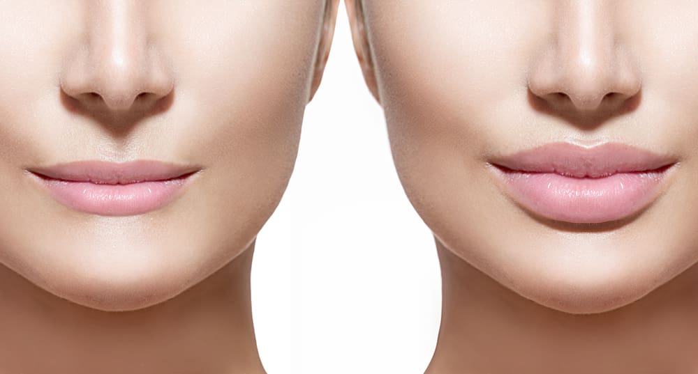 Lip filler injections. Before and after Treatment result photos in Baltimore, MD | Green Relief Health, LLC