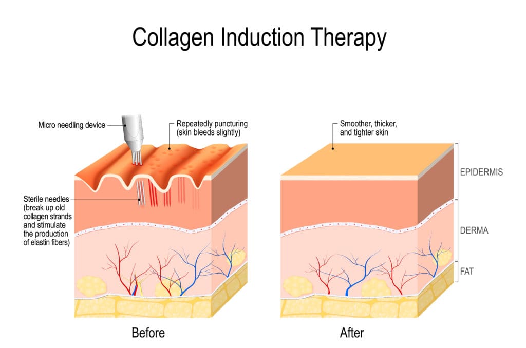 Collagen Induction Therapy in Baltimore, MD | Green Relief Health, LLC