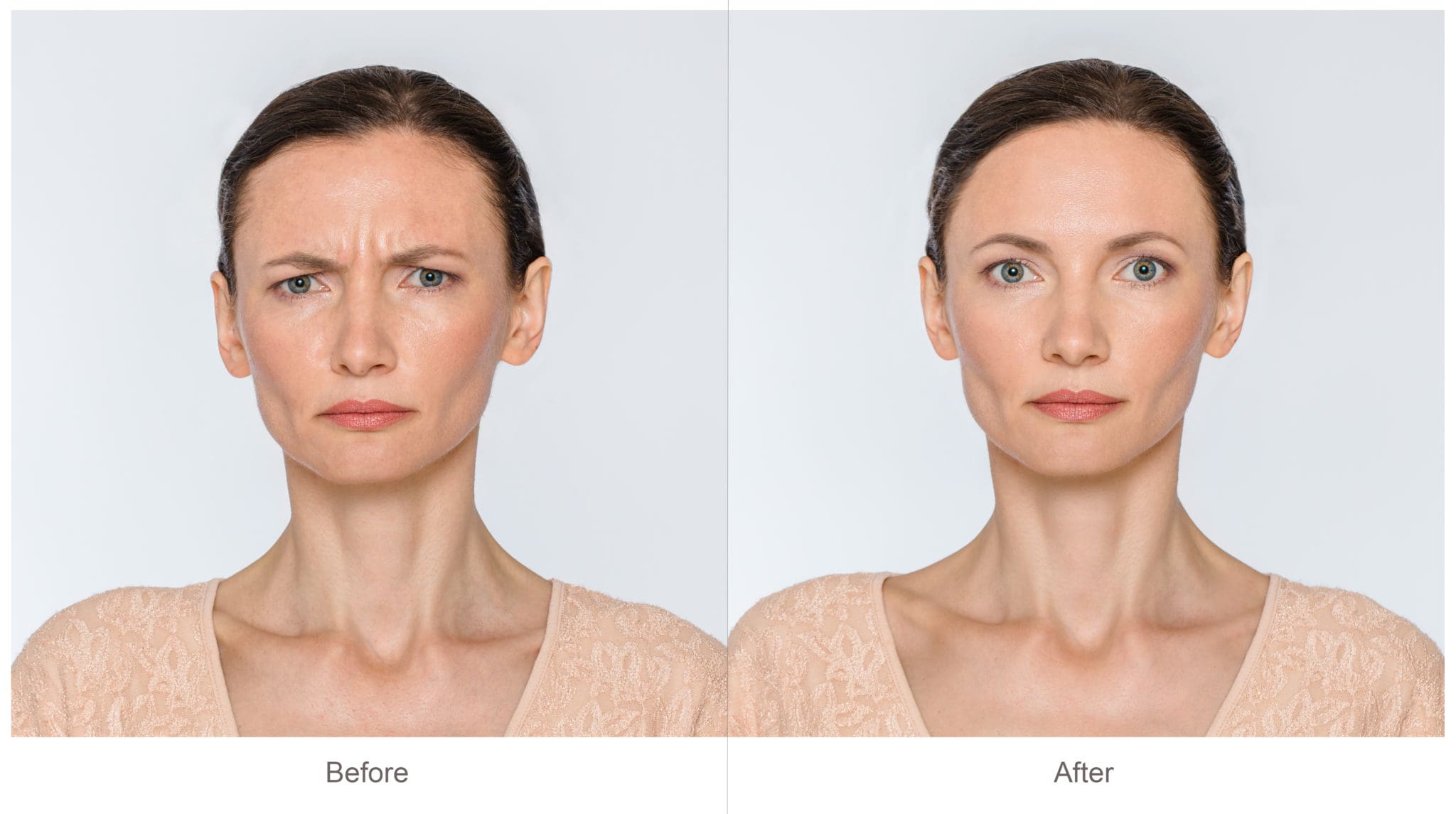 Botox Before and After Treatment result photos in Baltimore, MD | Green Relief Health, LLC