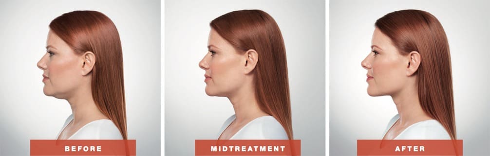 Kybella Before and After Treatment result photos in Baltimore, MD | Green Relief Health, LLC
