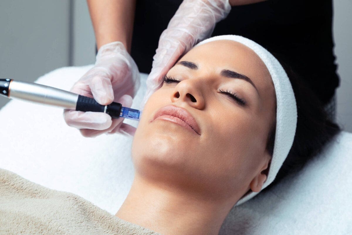 What Are The Benefits of Microneedling
