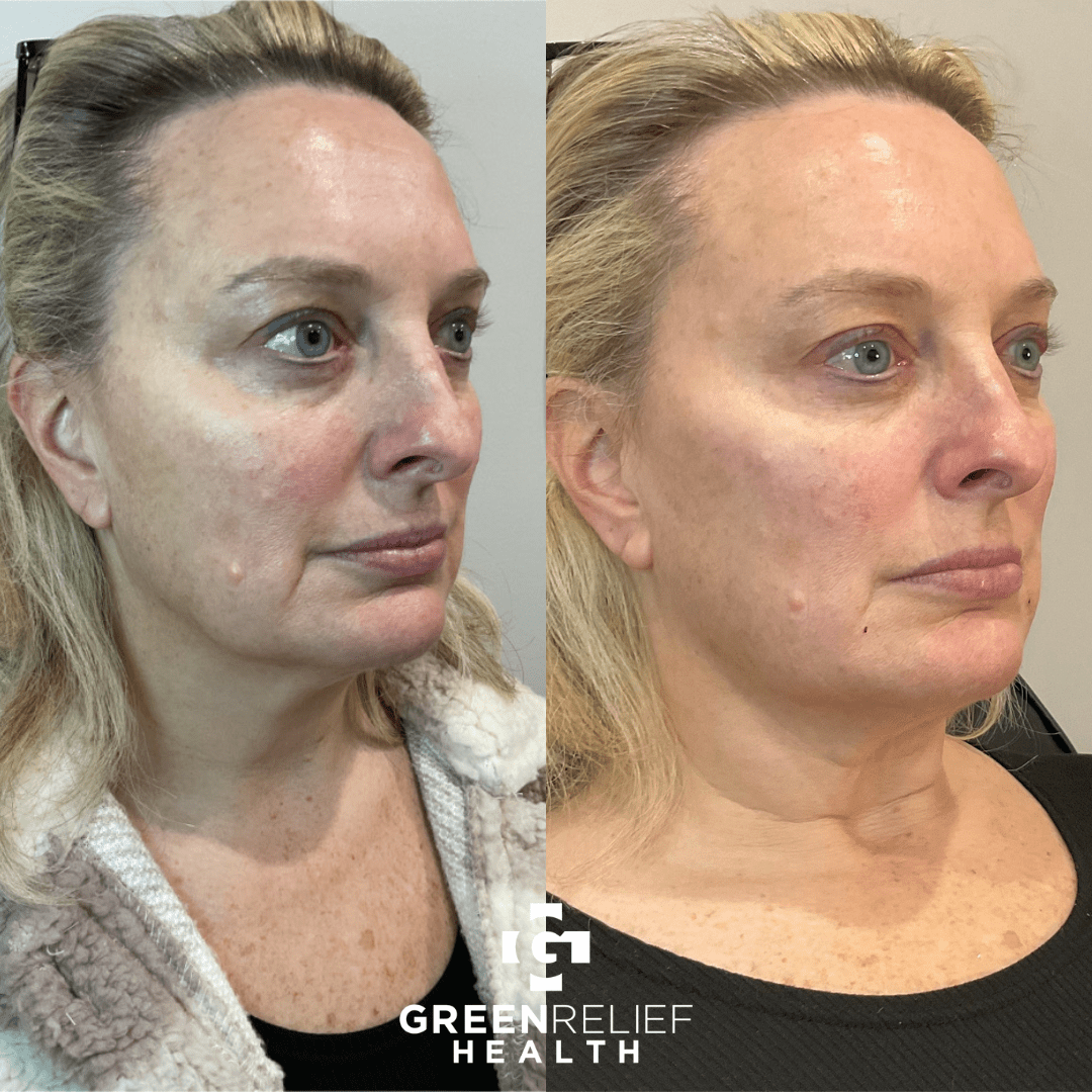 Before And After Dermal Fillers 1