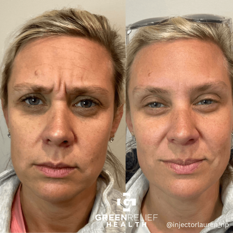 Before And After Botox 4 768x768