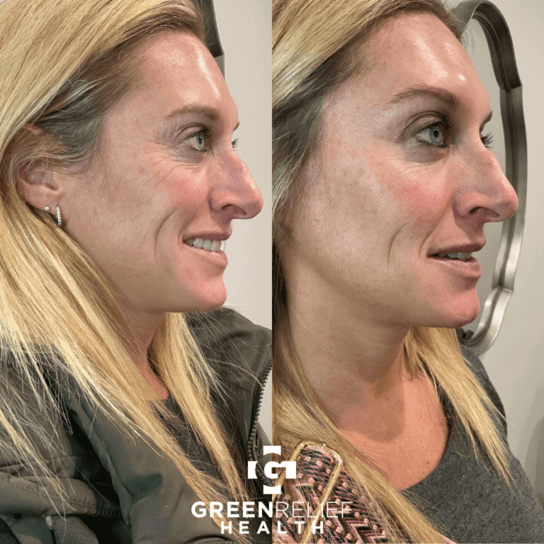 Before and after botox