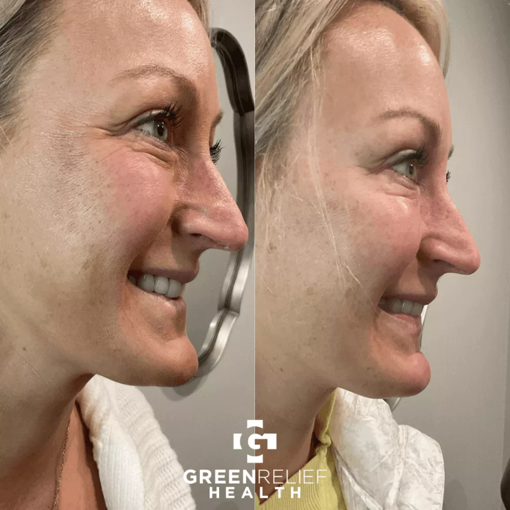 tirzepatide and botox BOTOX Cosmetic Injections Before After Botox for Teeth Grinding (Bruxism)