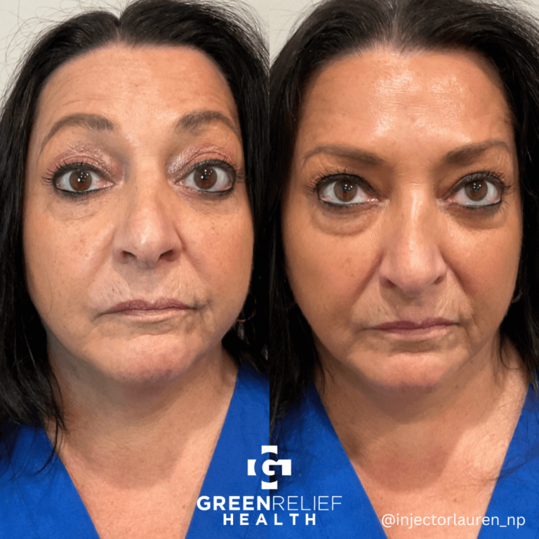 Before And After Botox 8 768x768