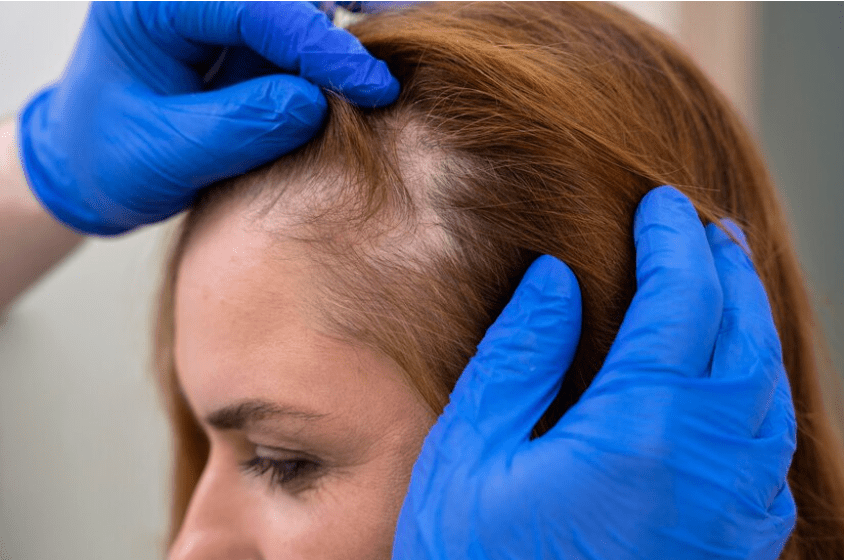 Does Ozempic Cause Hair Loss