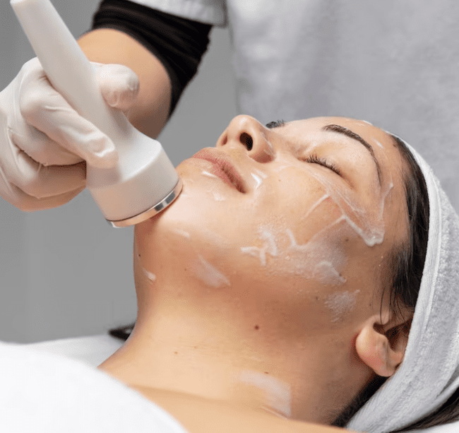Do Chemical Peels Help with Acne
