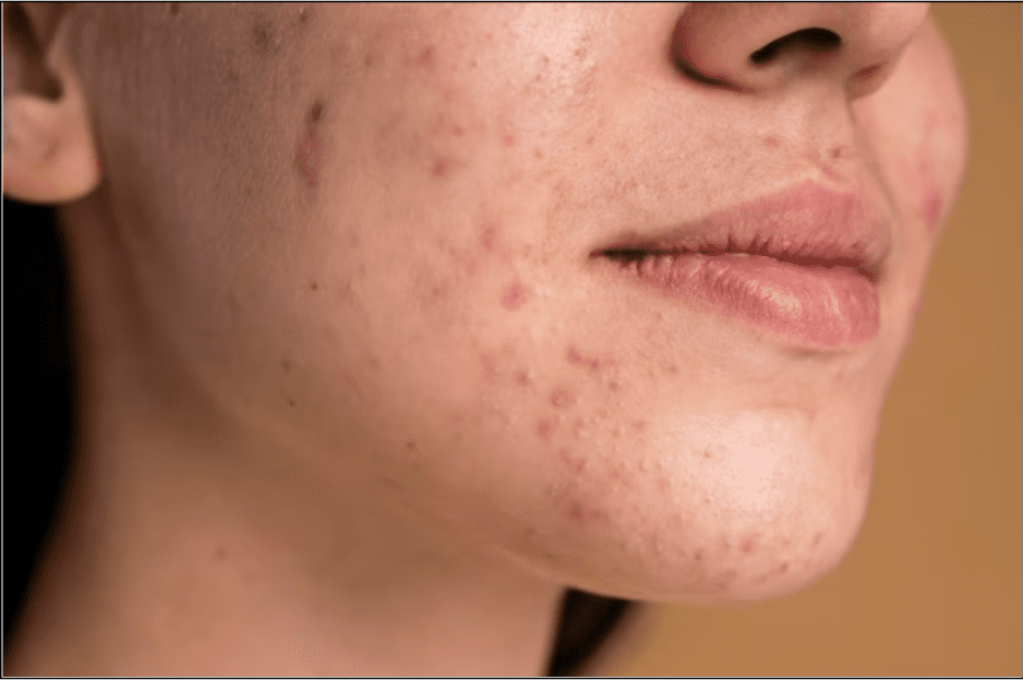 Does Stress Cause Acne