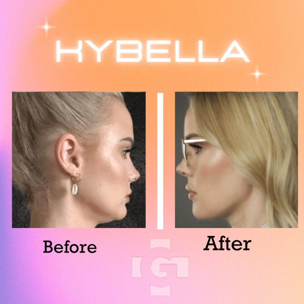 Kybella before and After