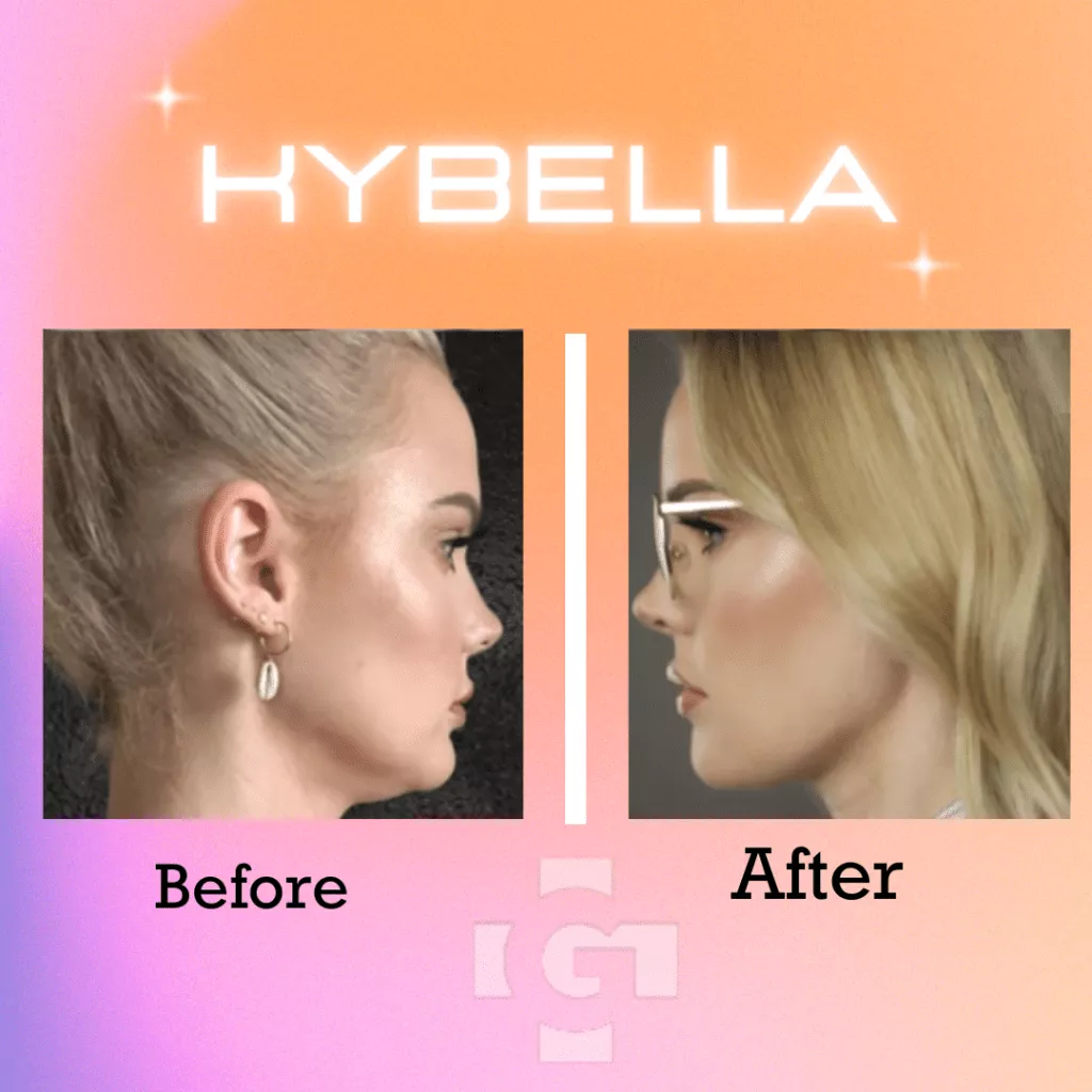 Kybella before and After