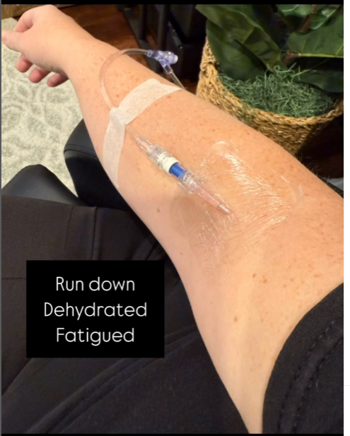 Close-up of an arm receiving IV therapy, labeled with 'Run down, Dehydrated, Fatigued,' highlighting treatment for exhaustion and hydration.