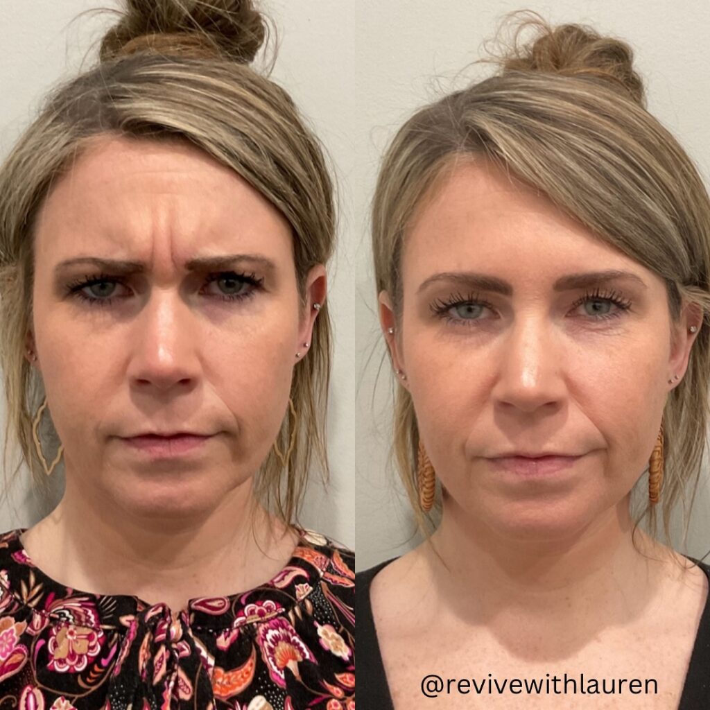 Before and after Botox treatment showing reduced forehead wrinkles
