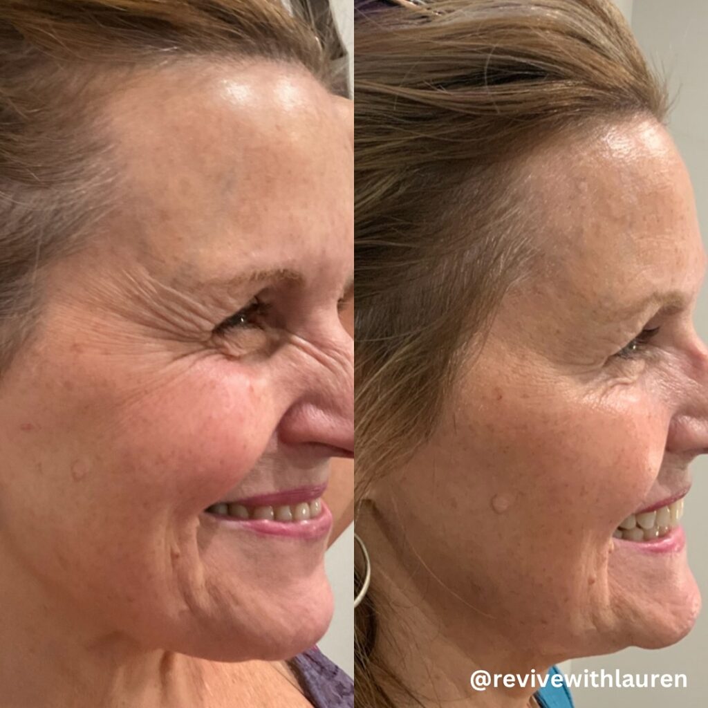Before and after Botox for crow's feet showing smoother eye area