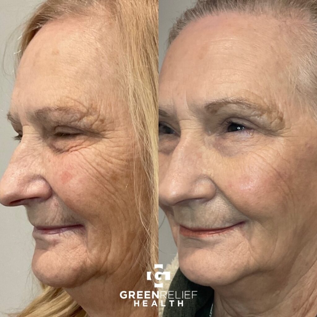 Side-by-side profile photos of an older woman before and after microneedling, showing smoother skin and reduced wrinkles.