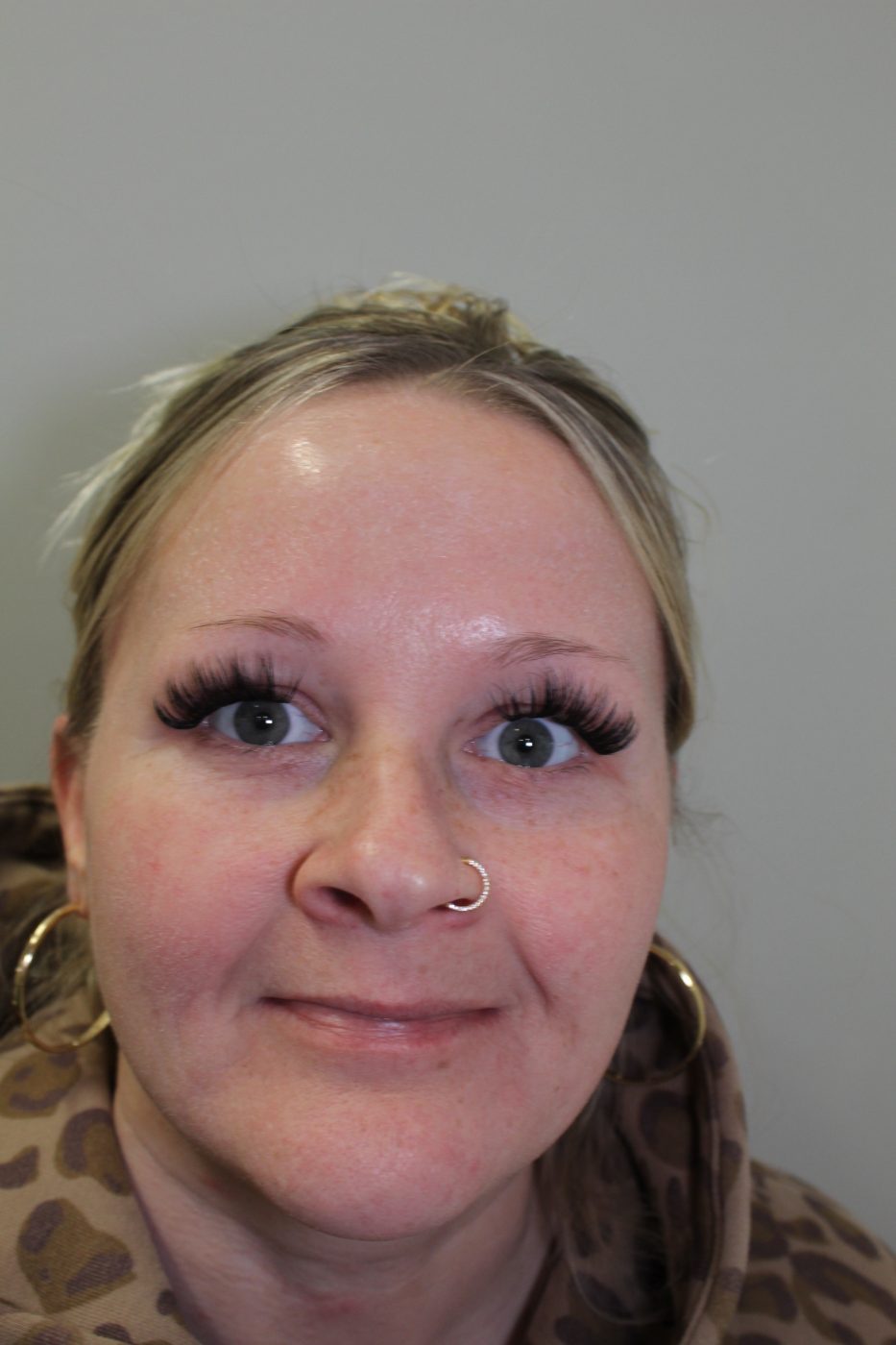 After Botox treatment at Green Relief Health