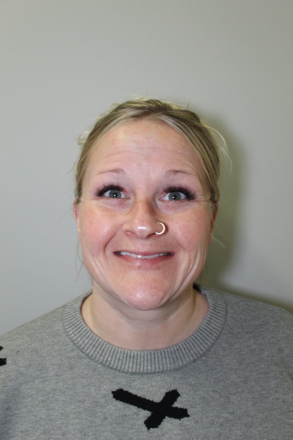 Before Botox treatment at Green Relief Health