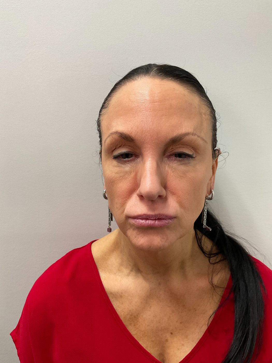 After Botox treatment at Green Relief Health