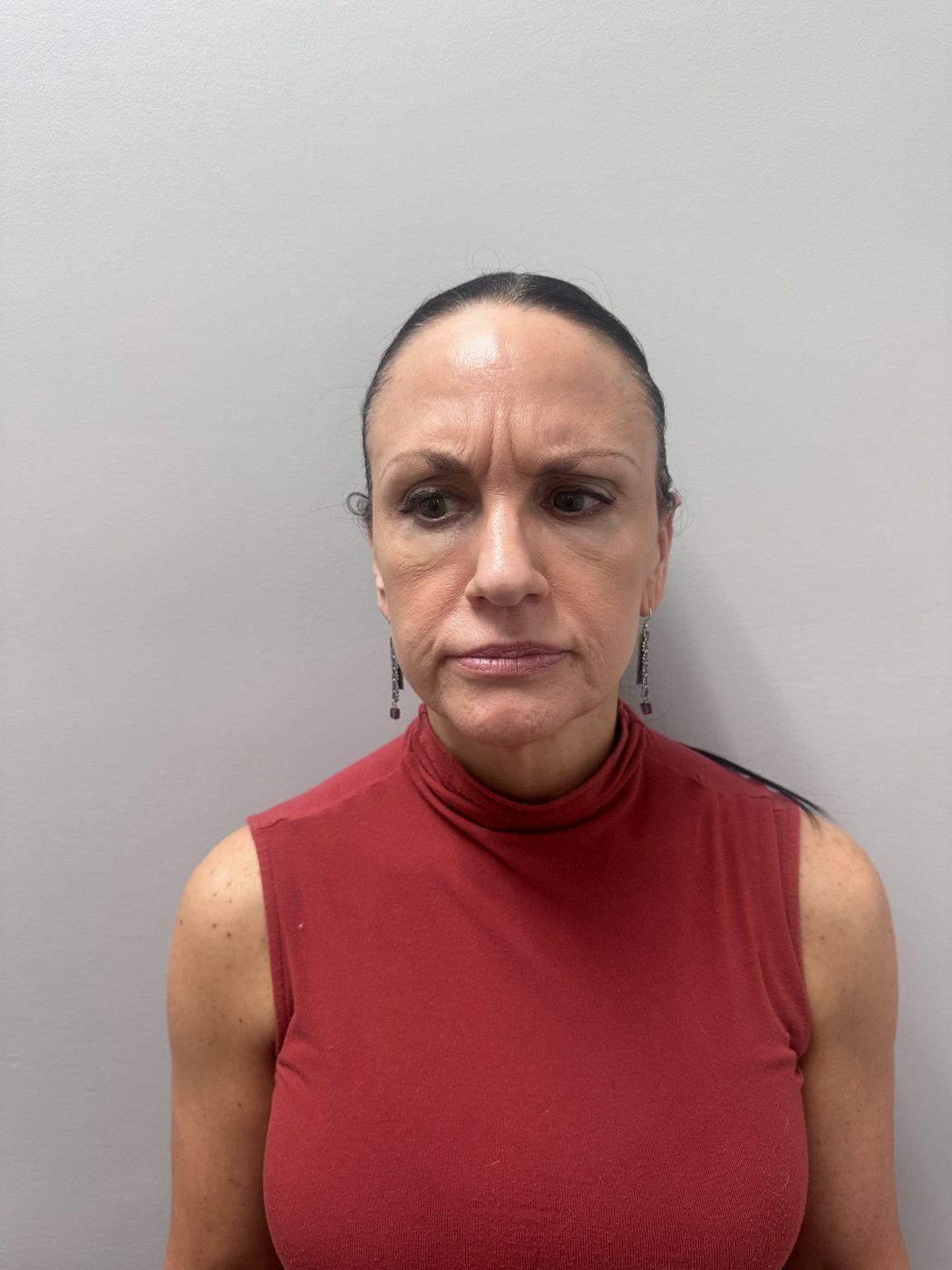 Before Botox treatment at Green Relief Health