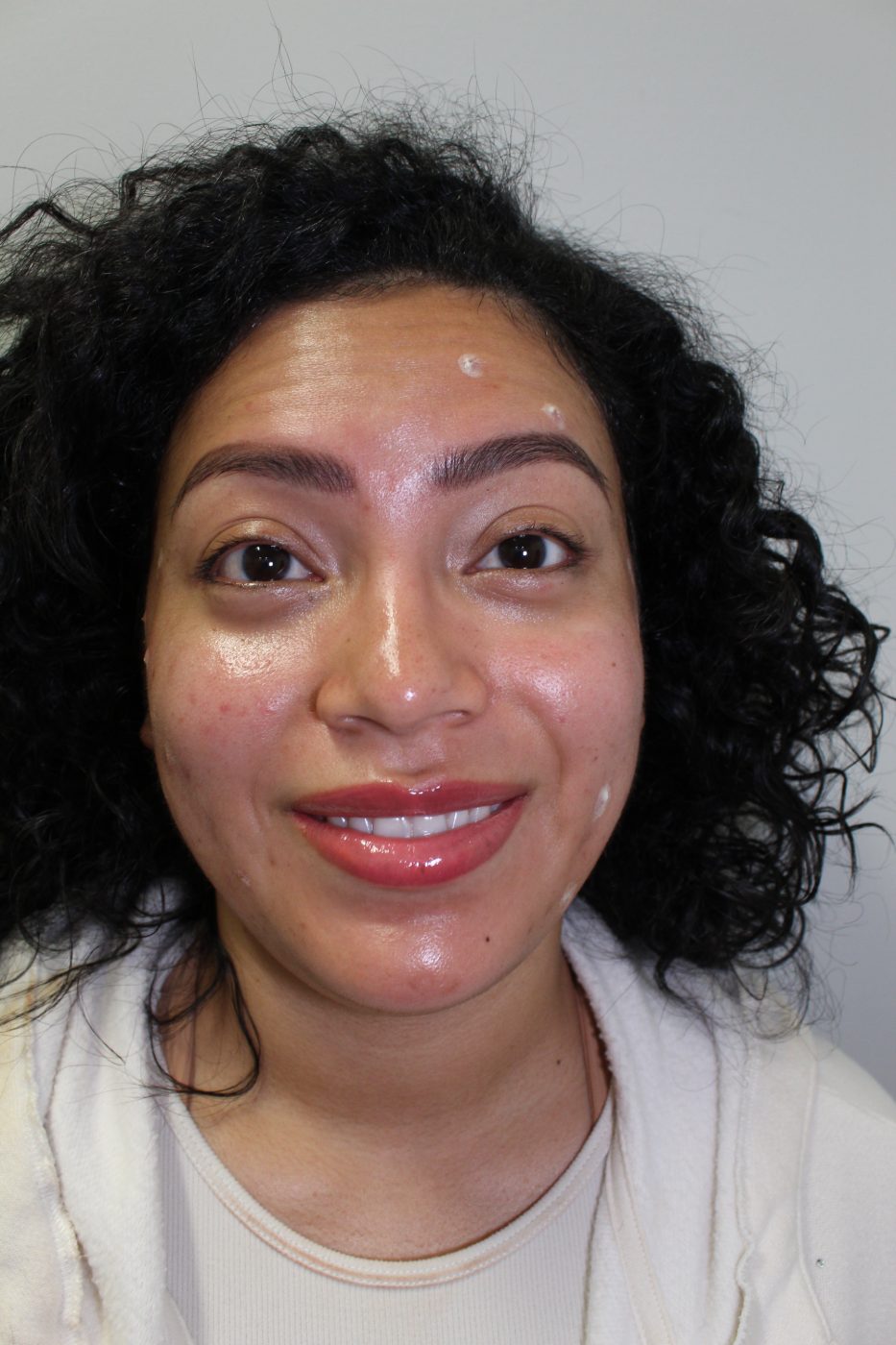 Before Botox treatment at Green Relief Health