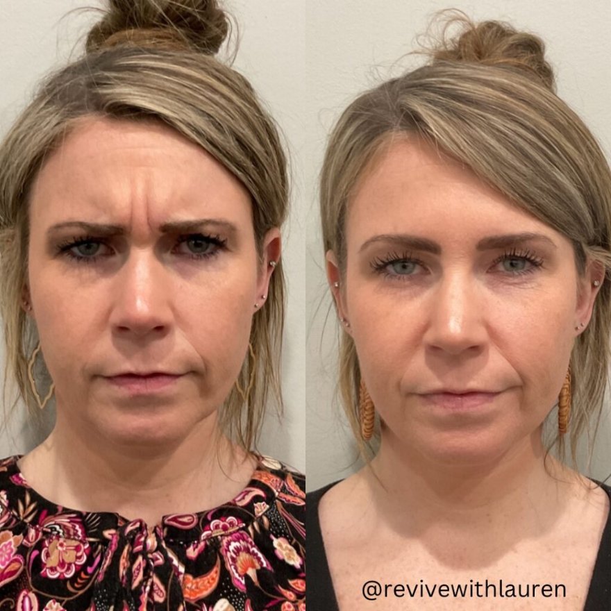Before and after a treatment at Green Relief Health
