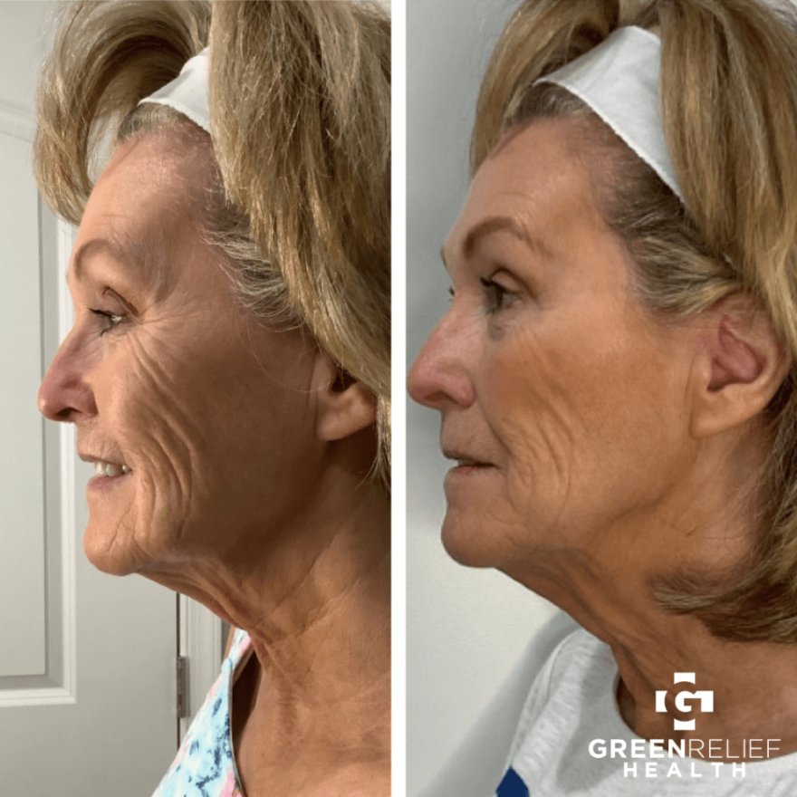 Before and after a treatment at Green Relief Health