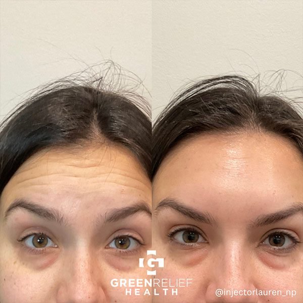 Before and after a treatment at Green Relief Health