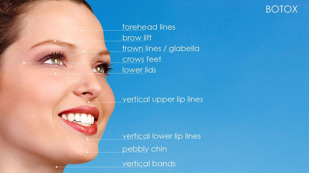 Facial treatment areas planned before Botox injections