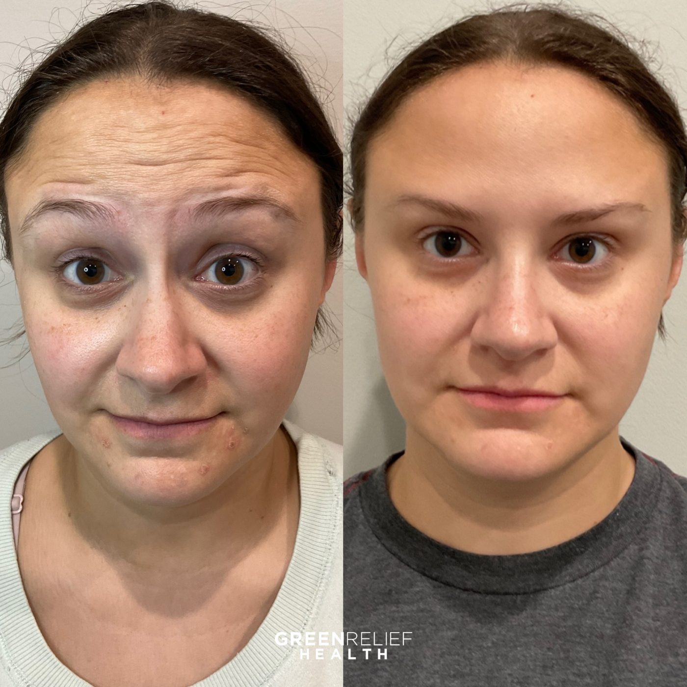 Before and after botox at Green Relief Health