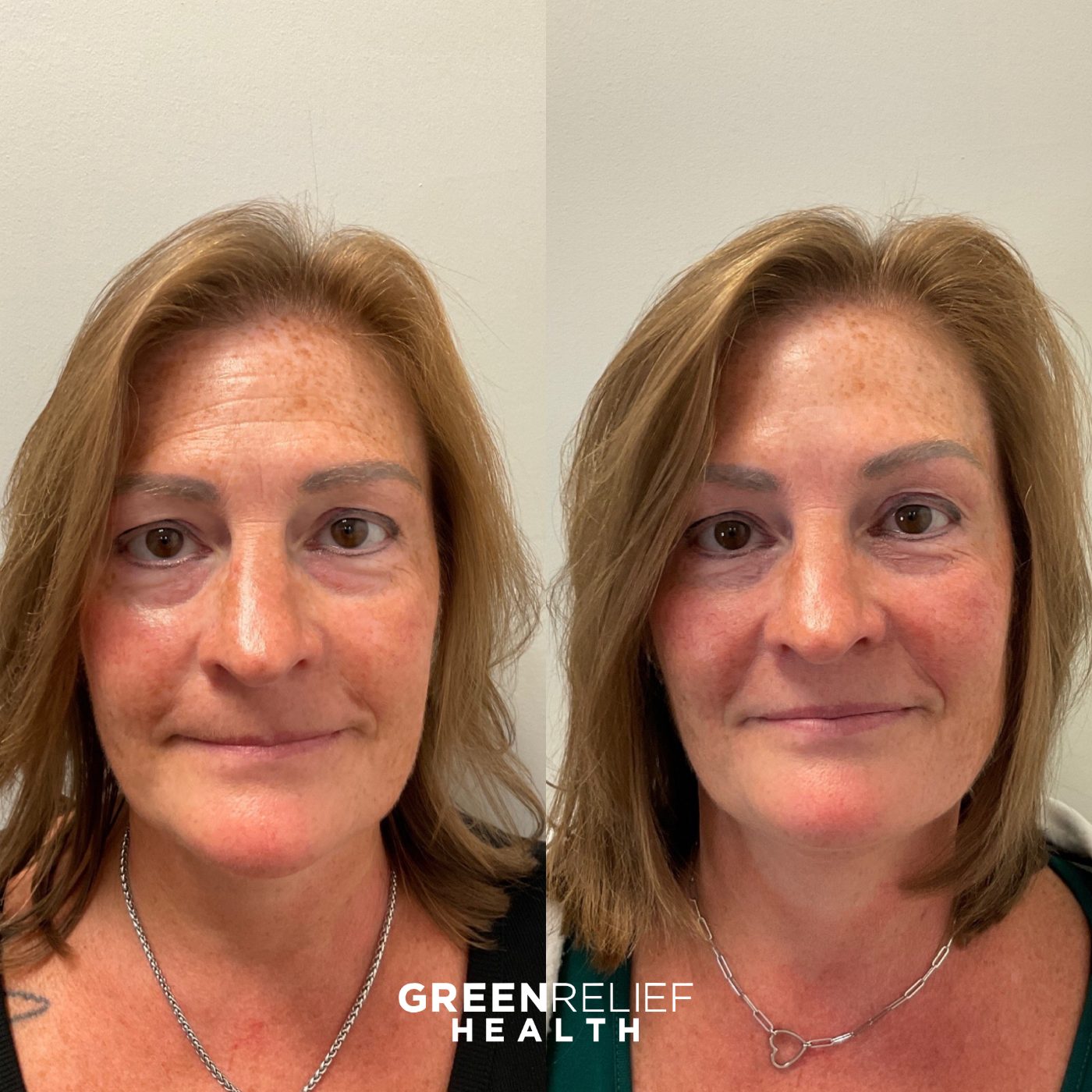 Before and after botox at Green Relief Health