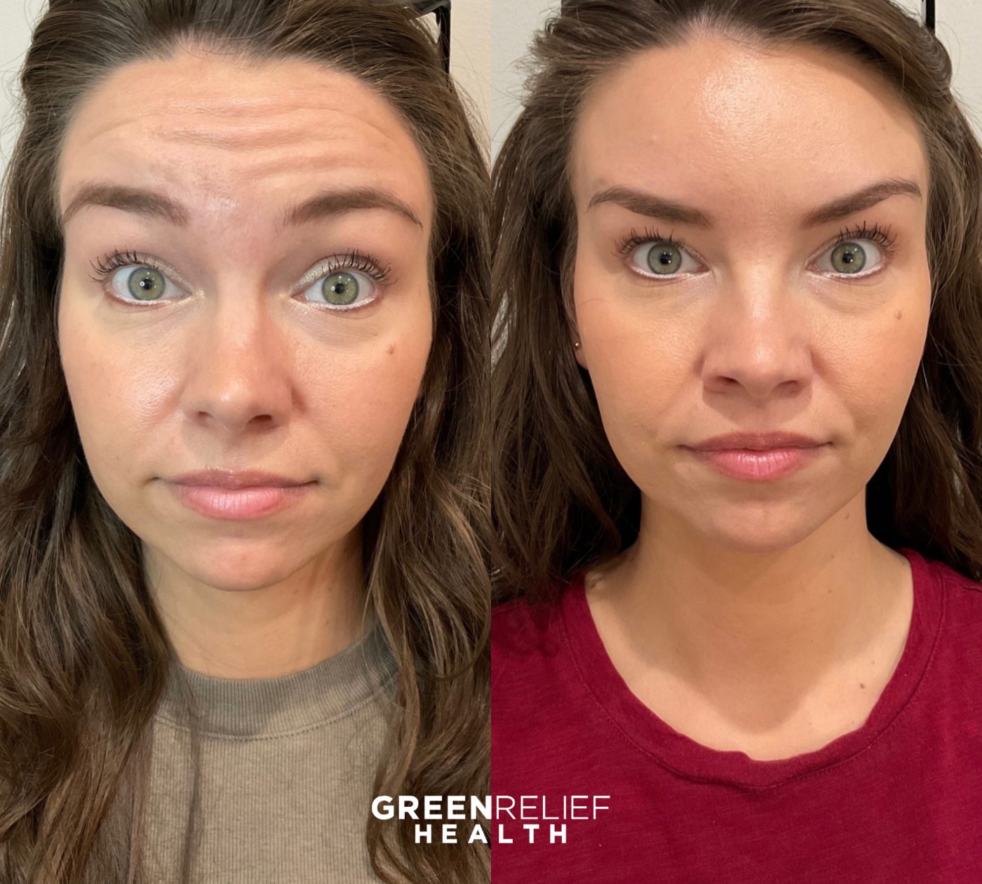 Before and after botox at Green Relief Health