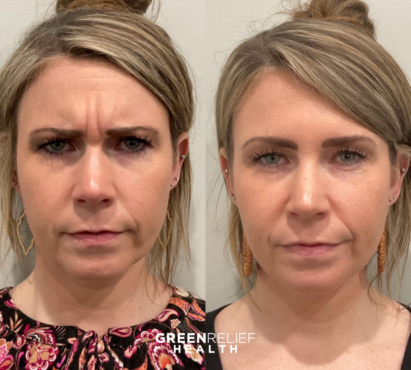 Before and after botox at Green Relief Health