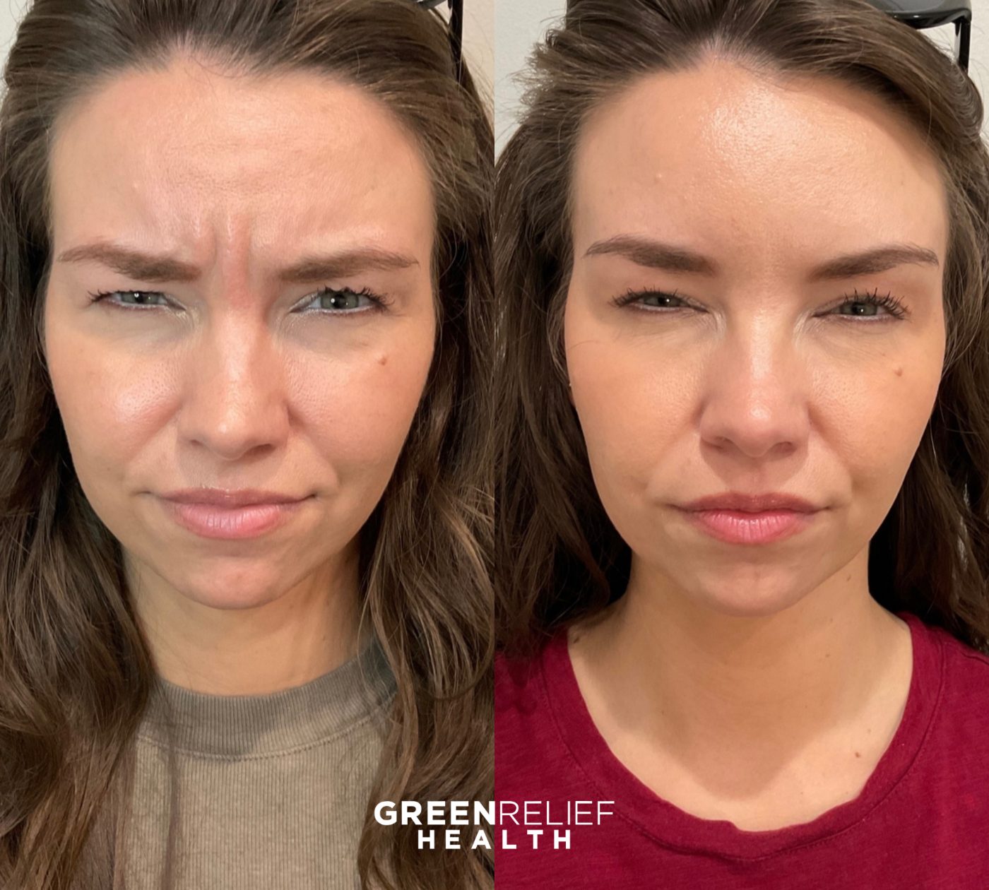 Before and after botox at Green Relief Health
