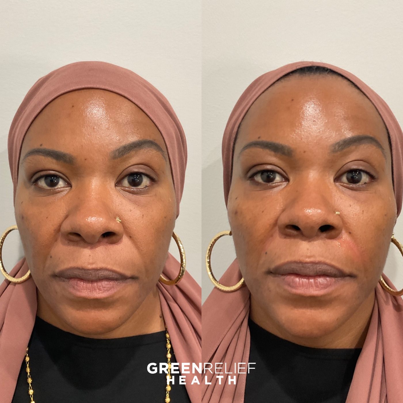 Before and after facial balancing at Green Relief Health