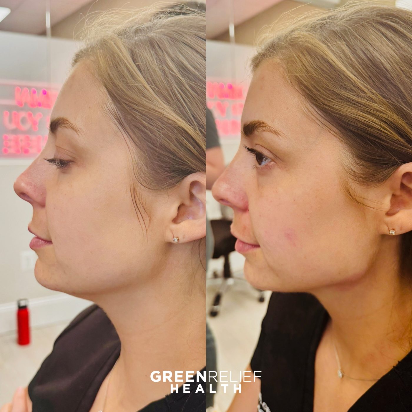 Before and after facial filler at Green Relief Health