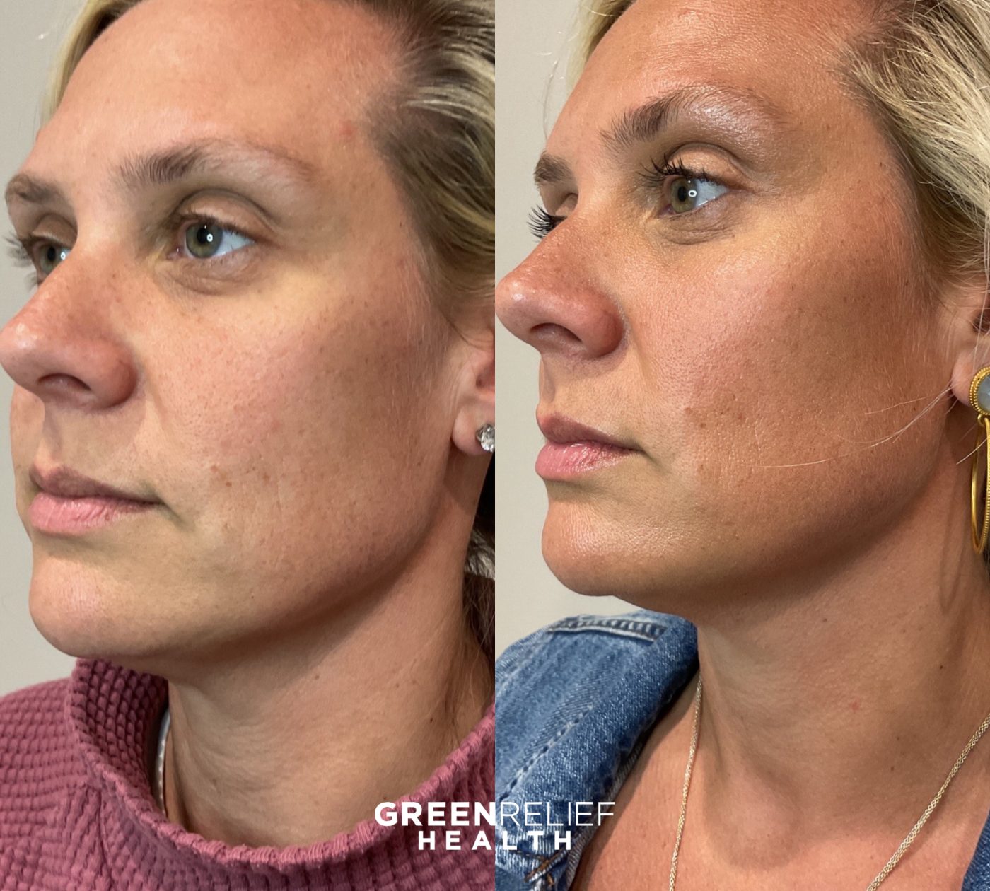 Before and after facial filler at Green Relief Health
