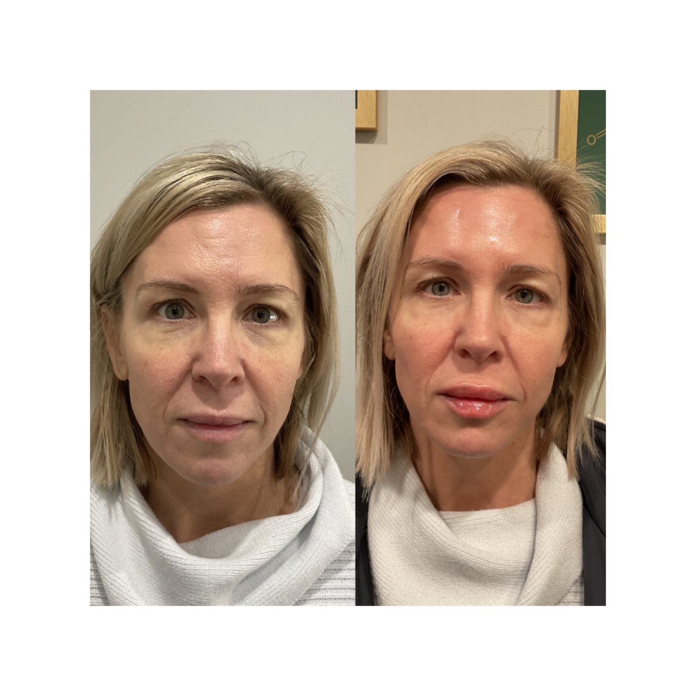 Before and after facial filler at Green Relief Health
