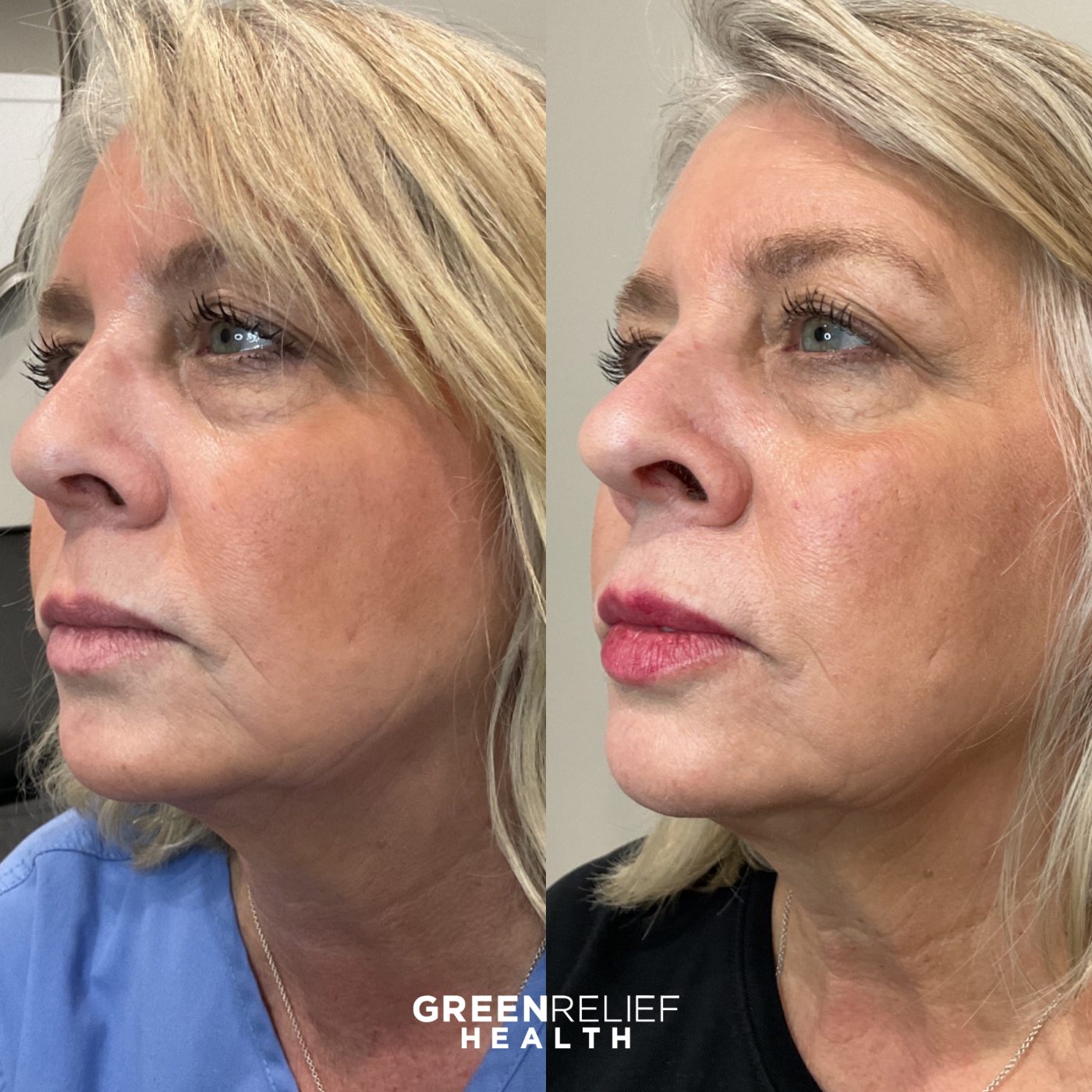 Before and after facial filler at Green Relief Health