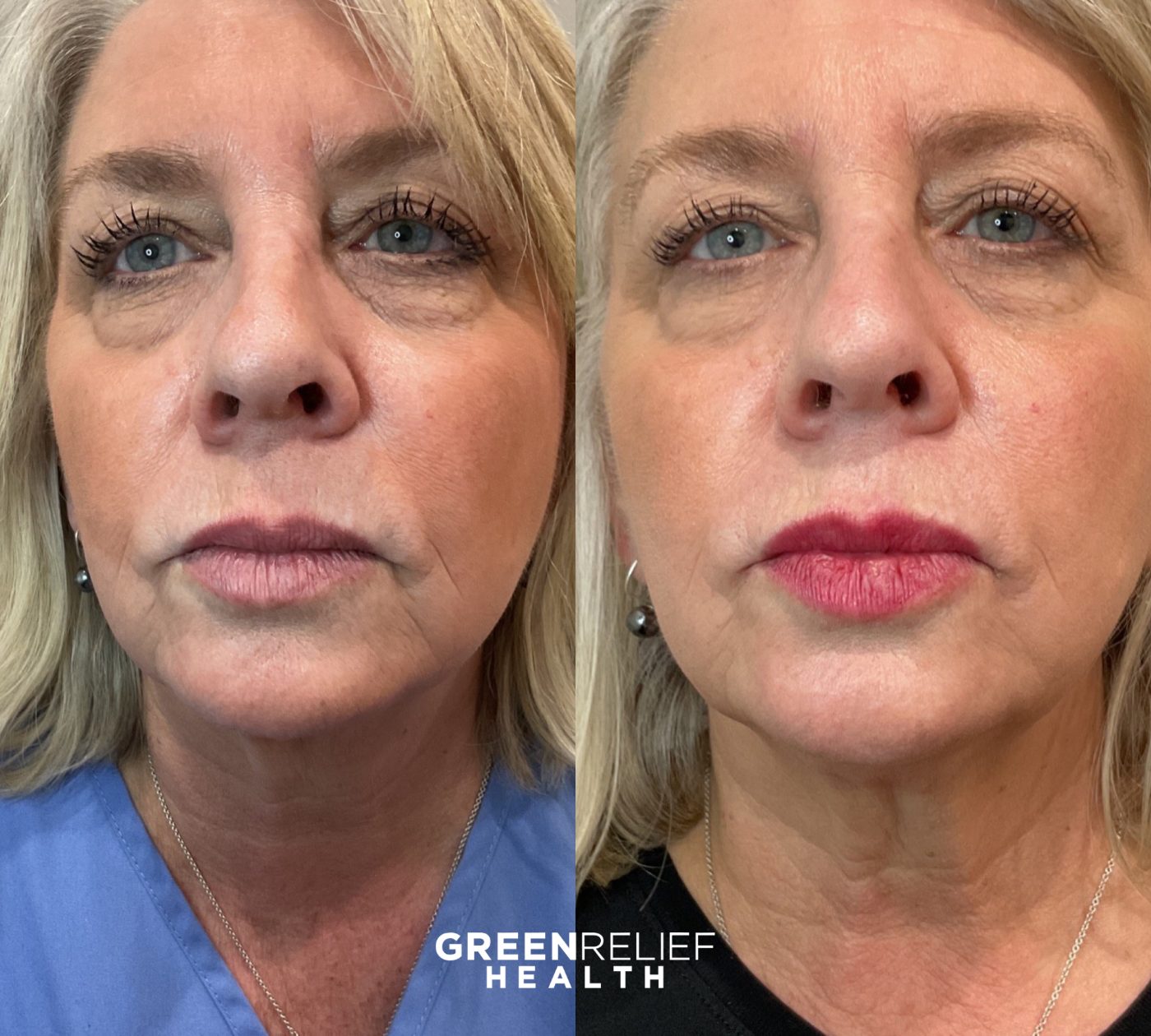 Before and after facial balancing at Green Relief Health