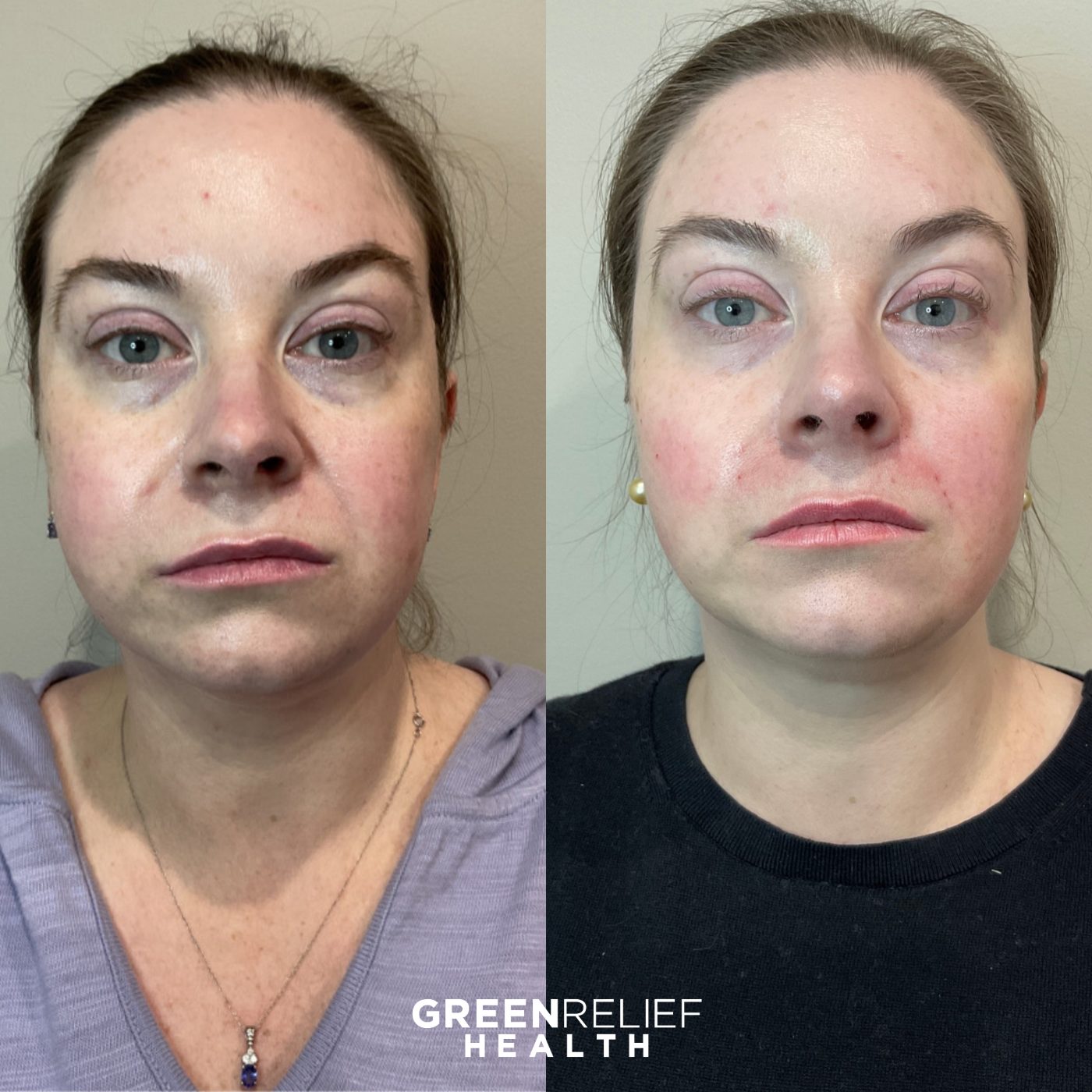 Before and after facial filler at Green Relief Health