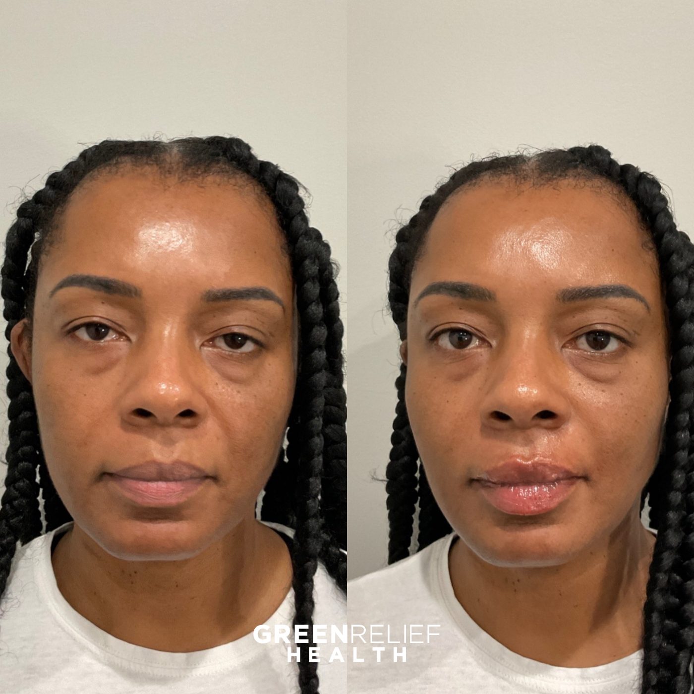 Before and after facial balancing at Green Relief Health