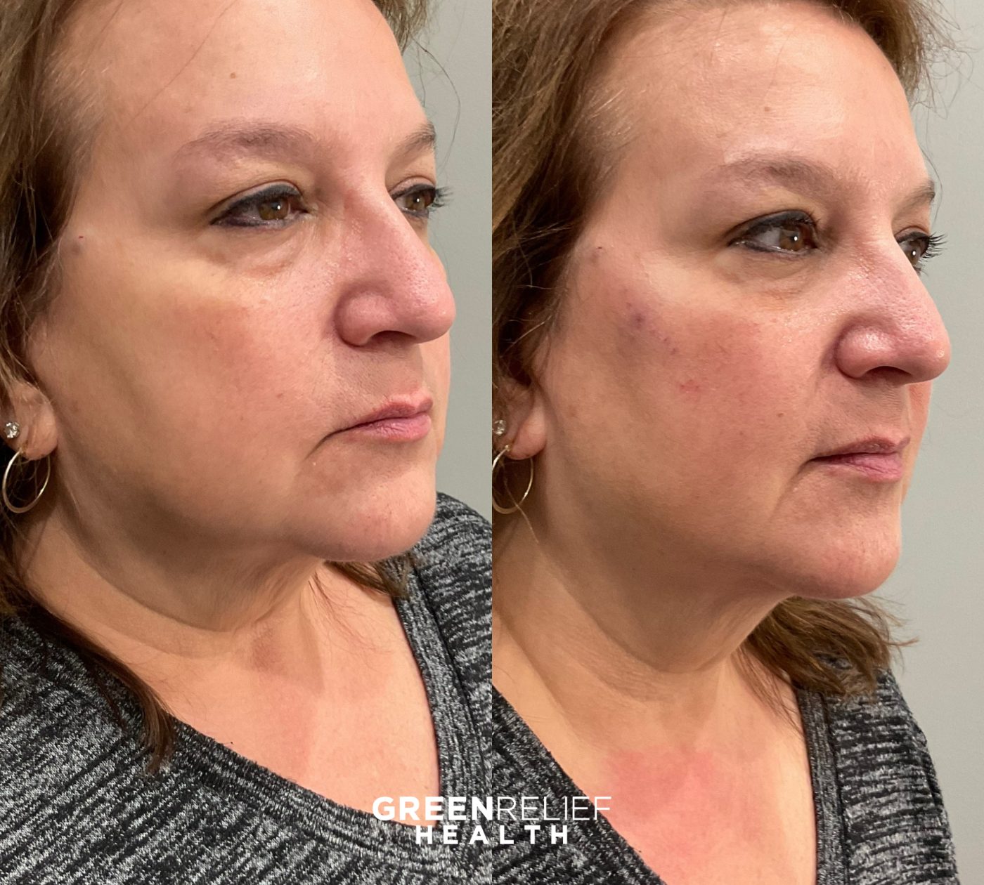 Before and after midface filler at Green Relief Health