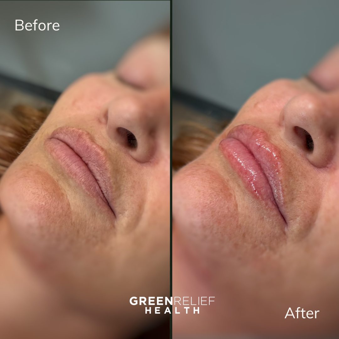 Before and after lip filler at Green Relief Health