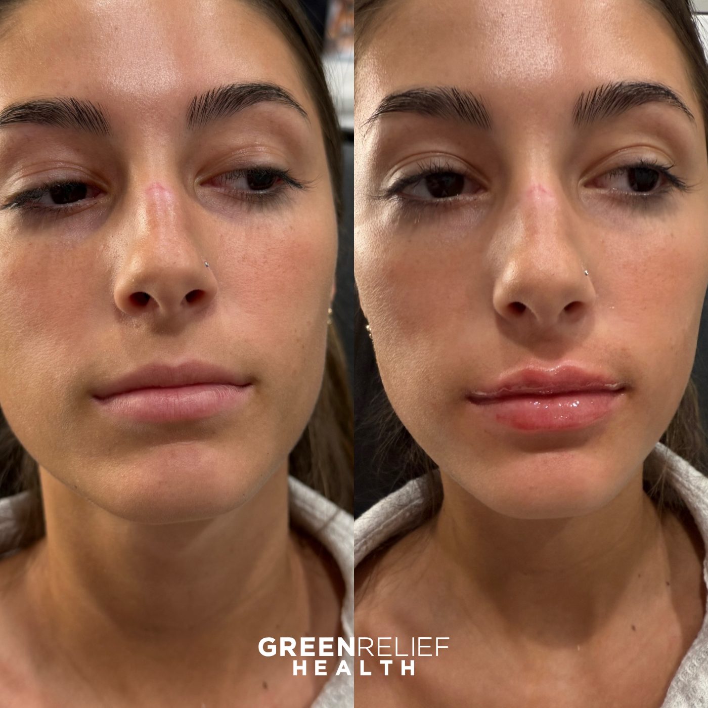 Before and after lip filler at Green Relief Health