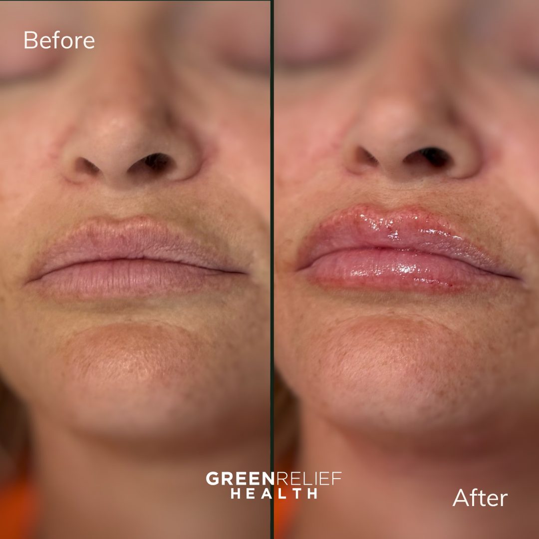 Before and after lip filler at Green Relief Health